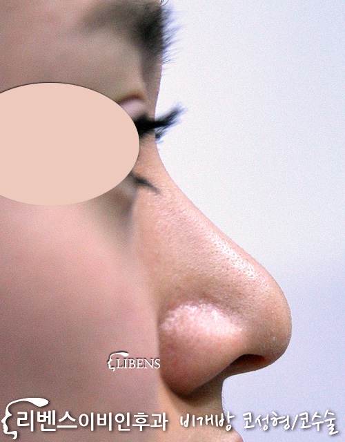 여성 비익연골 두상절제 코끝연골묶기 코끝성형만 성형 s95